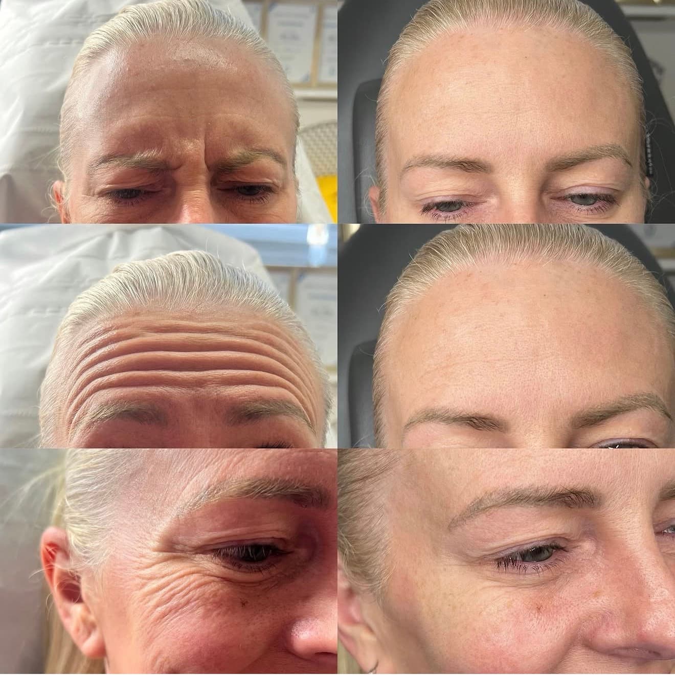 Anti-Wrinkle · Forehead