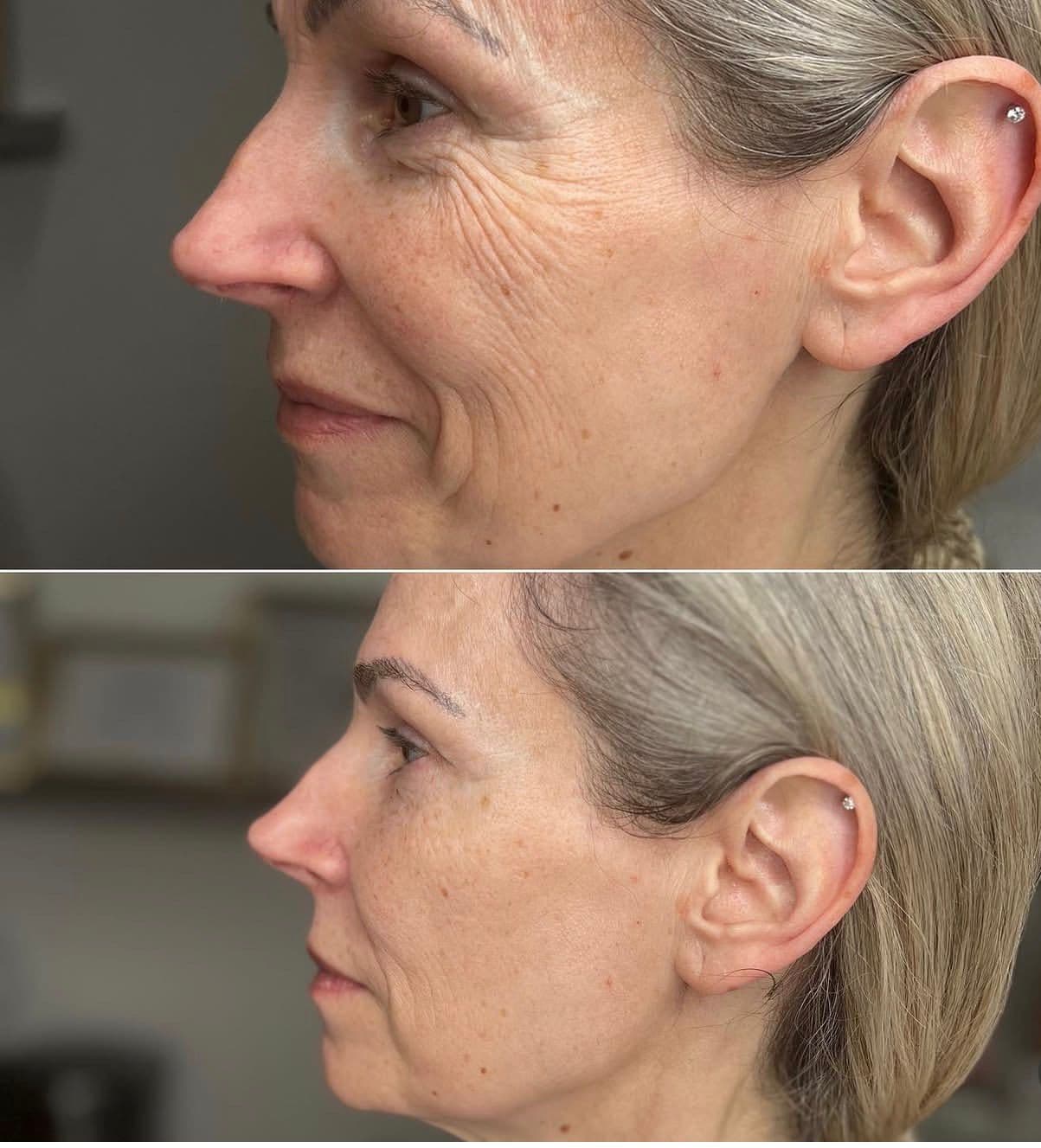 HIFU & RF Microneedling