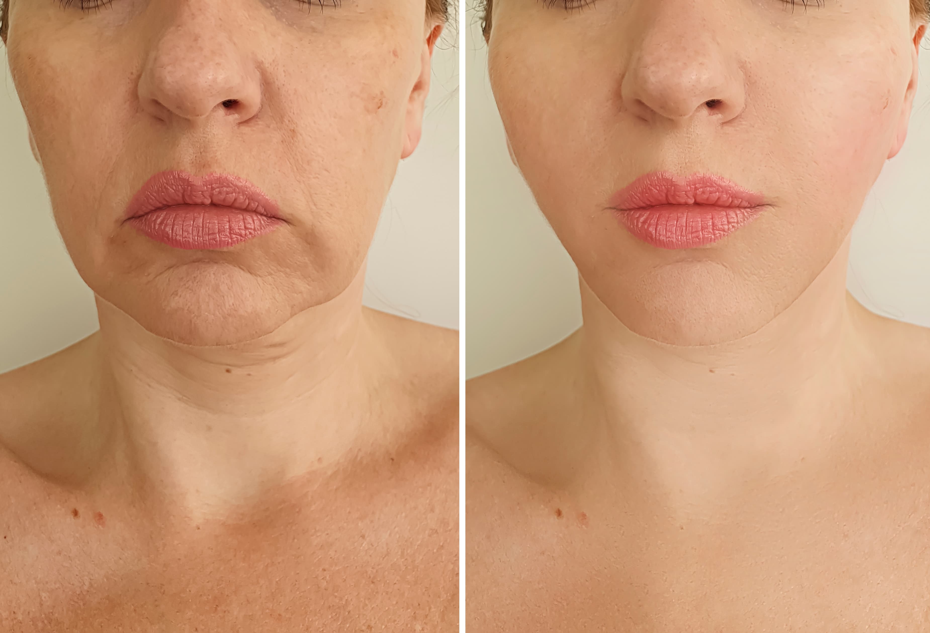 Face & Jawline Fillers