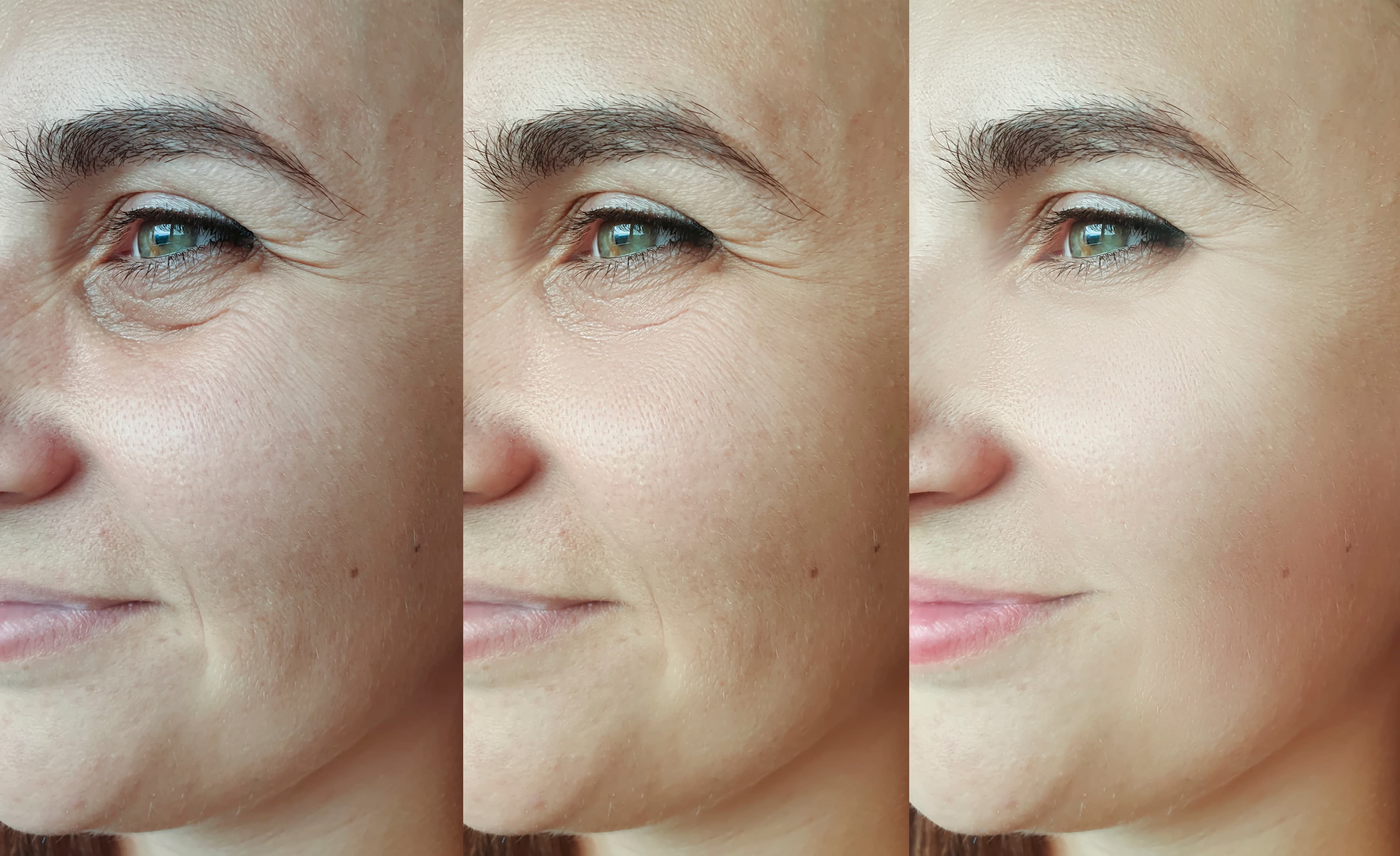Skin Rejuvenation
